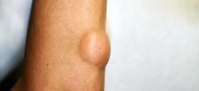 lipoma Lipóma: Minden tudnivaló