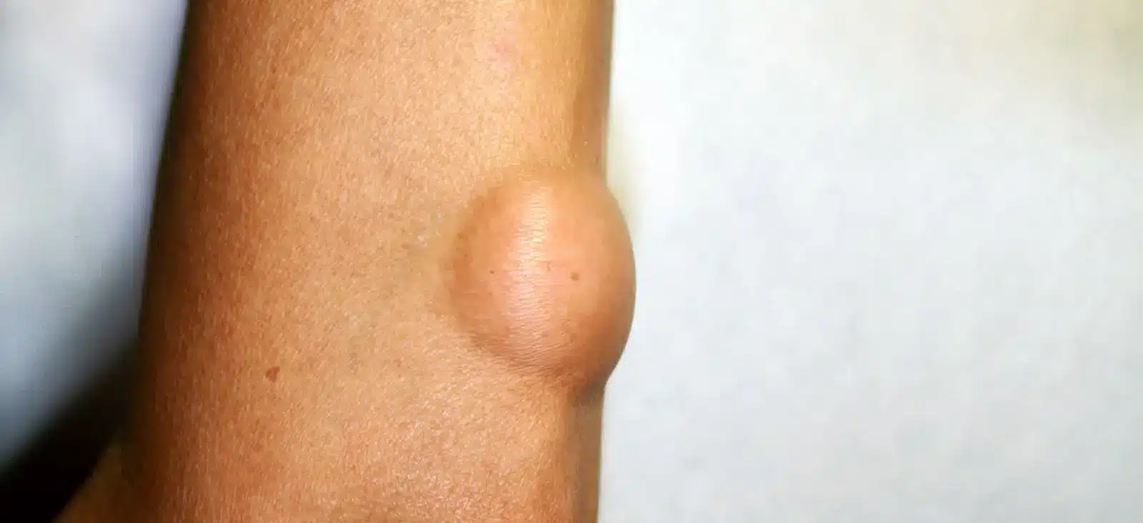 lipoma Lipóma: Minden tudnivaló