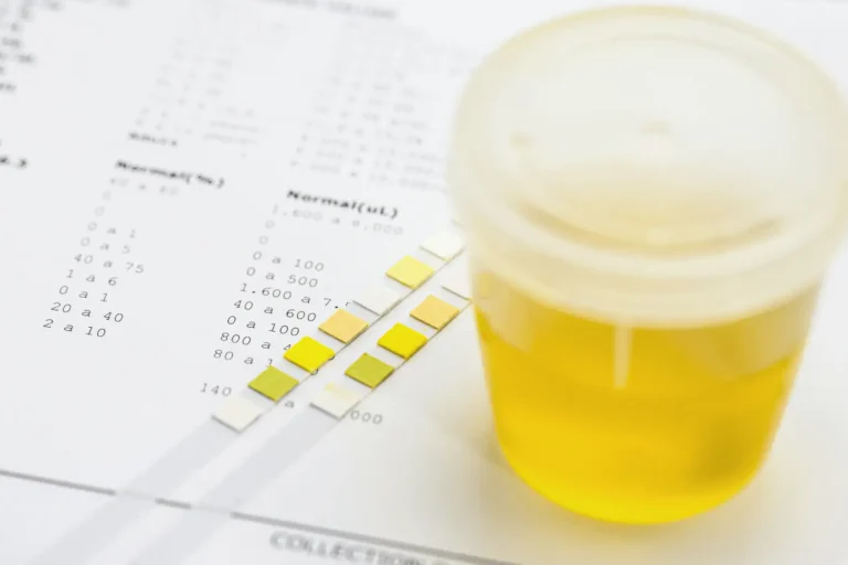 Kálcium-oxalát vizeletvizsgálat vesekő esetén