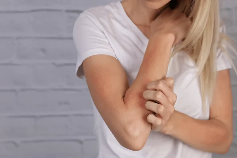 Ekcéma kezelés a Lotusz Medical Centerben