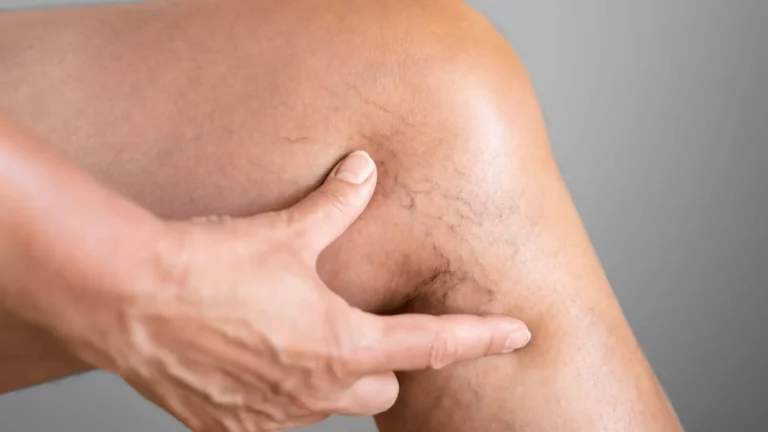 Érgyulladás (Vasculitis)
